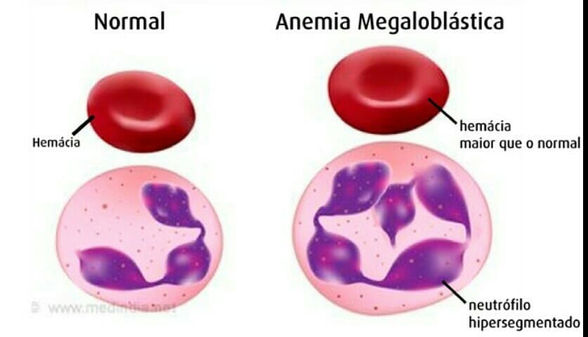 Anemia Megaloblástica Y Su Relación Con La Nutrición 